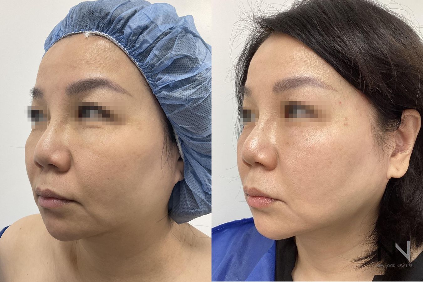 Before and after chin liposuction four months results - Angle 2