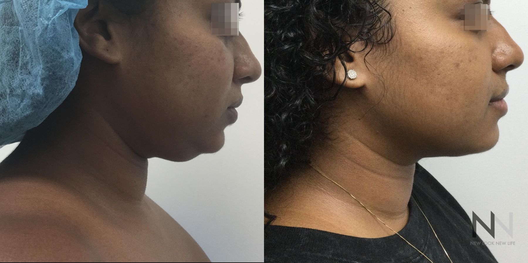 Submental liposuction showing improved jawline contour