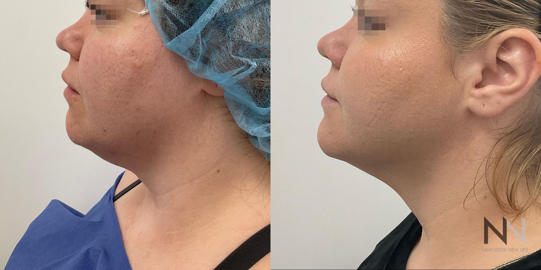 Before and after chin liposuction four months results - Angle 2