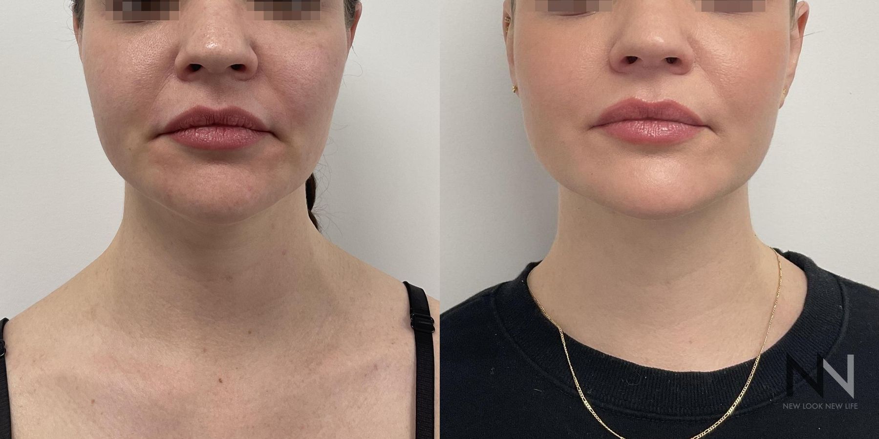 Submental liposuction showing improved jawline contour - Angle 4
