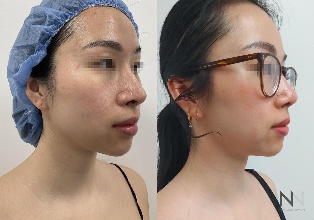 Chin Liposuction - Thumbnail 4