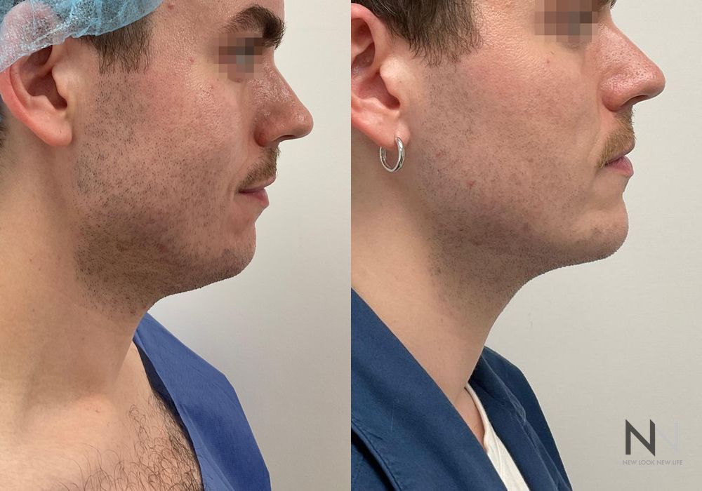 Chin Liposuction - Thumbnail 3