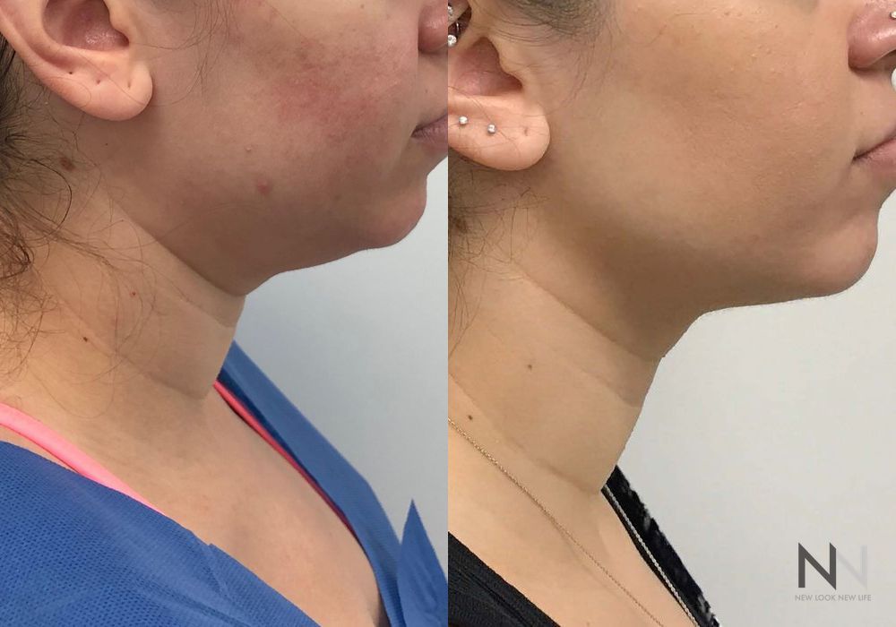 Chin Liposuction - Case 196