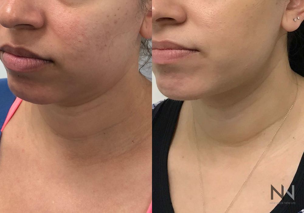 Chin Liposuction - Thumbnail 3