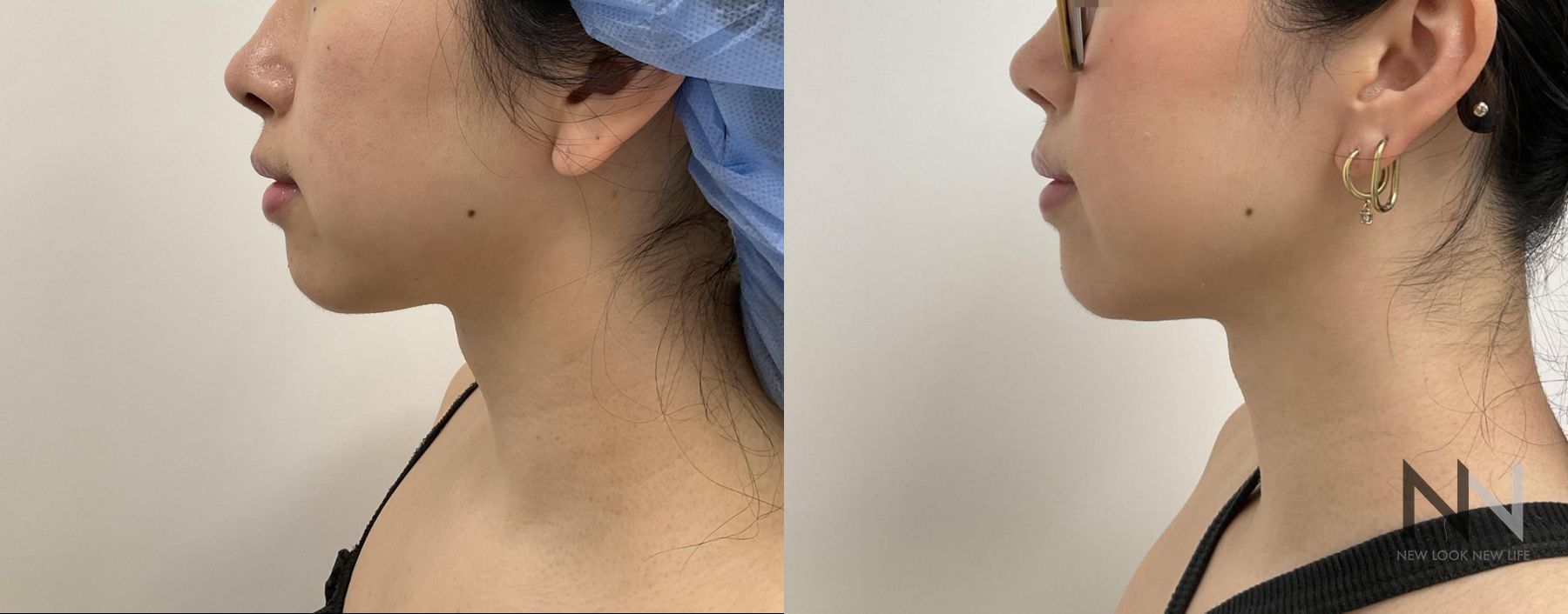 Before and after chin liposuction four months results
