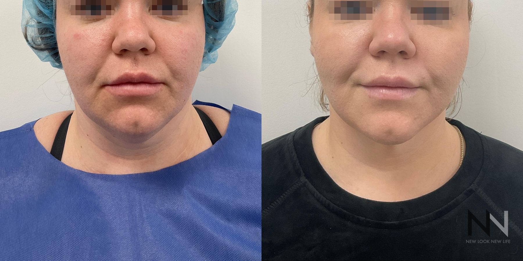 Before and after chin liposuction four months results - Angle 3