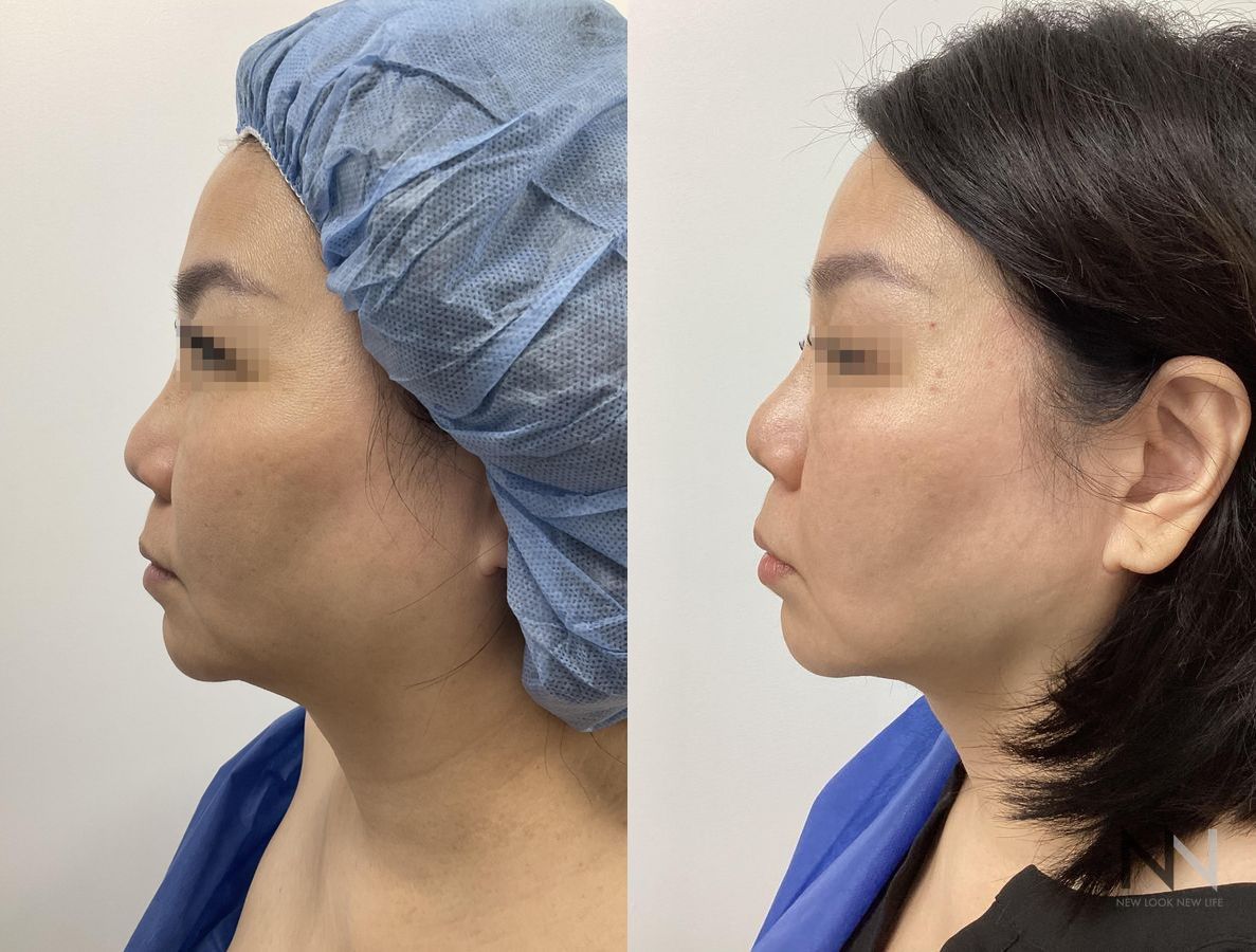 Before and after chin liposuction four months results