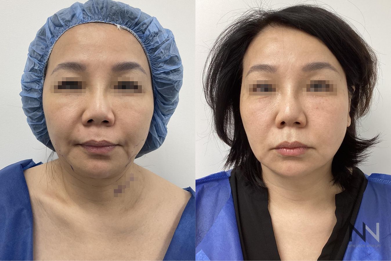 Before and after chin liposuction four months results - Angle 3
