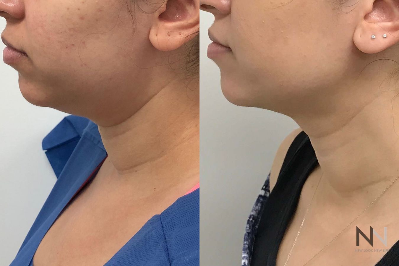 Submental liposuction showing improved jawline contour