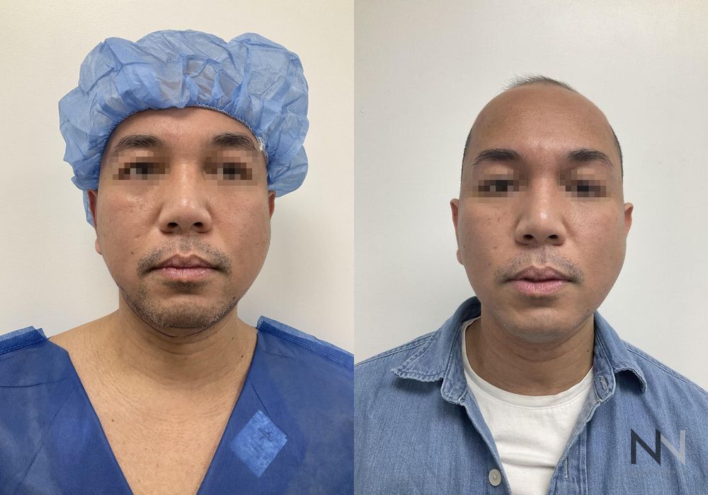 Chin Liposuction - Thumbnail 3