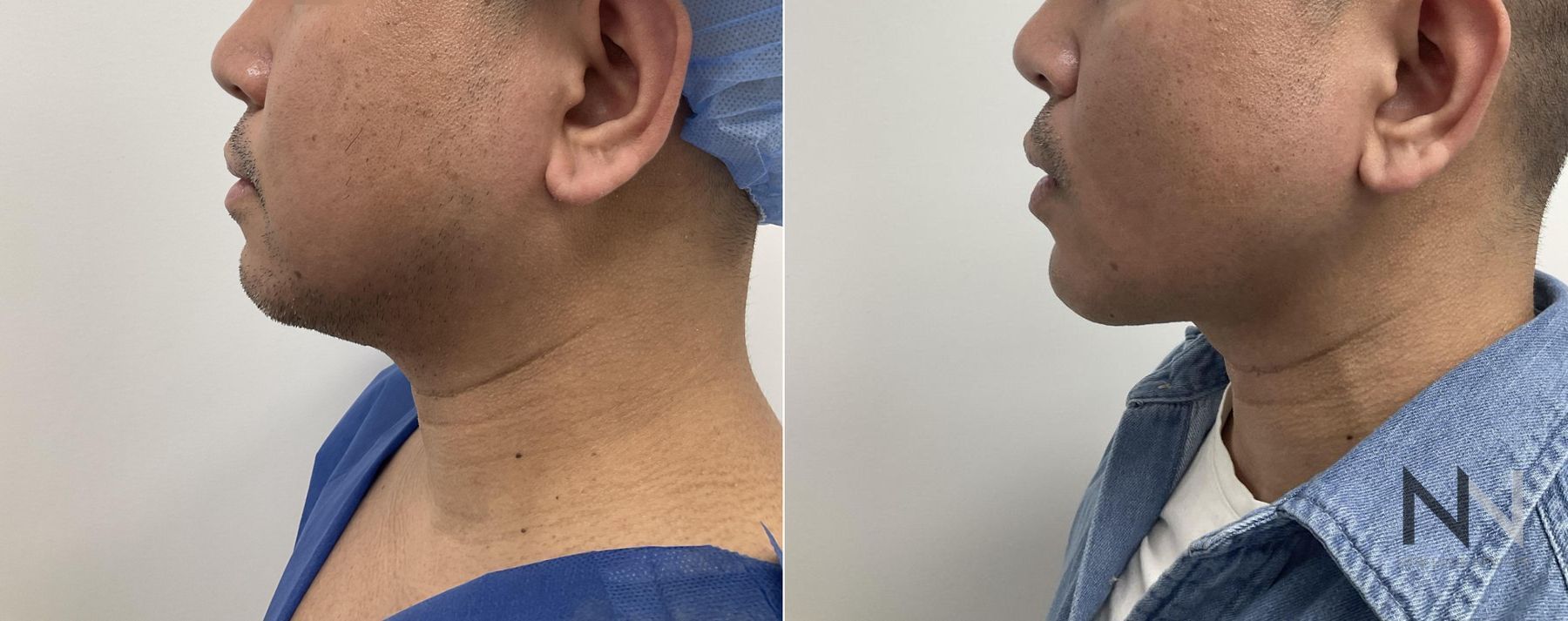 Submental liposuction showing improved jawline contour