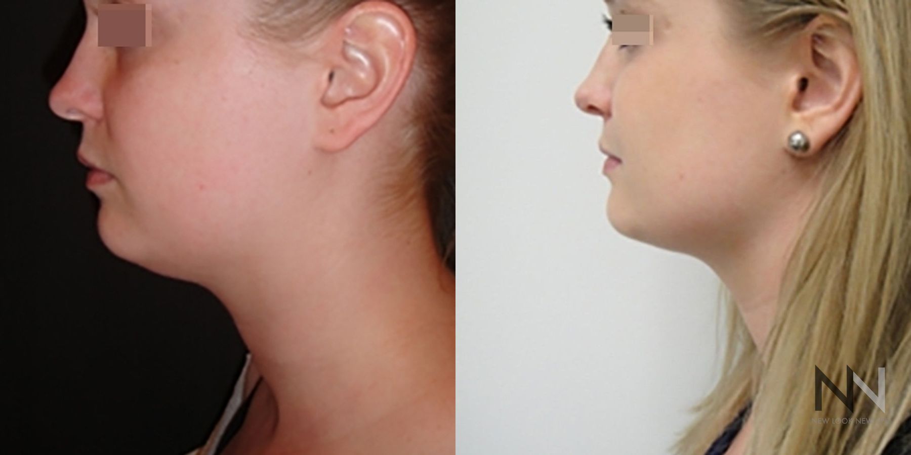 Submental liposuction showing improved jawline contour - Angle 4