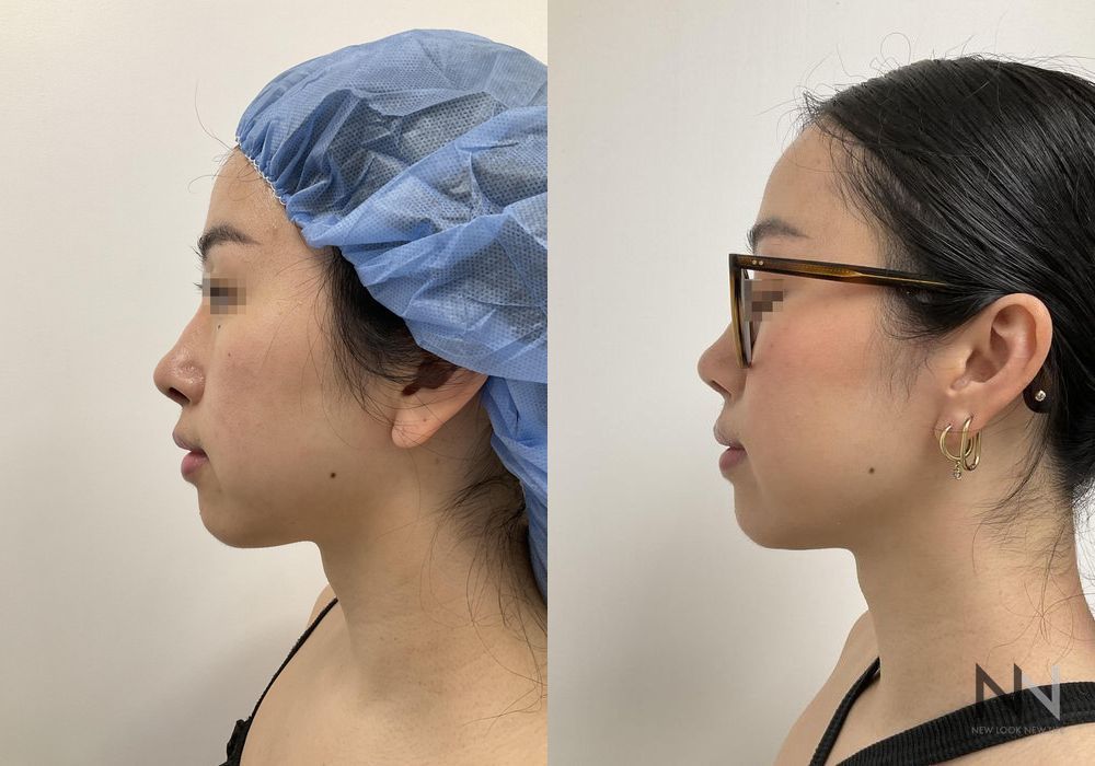 Chin Liposuction - Case 204