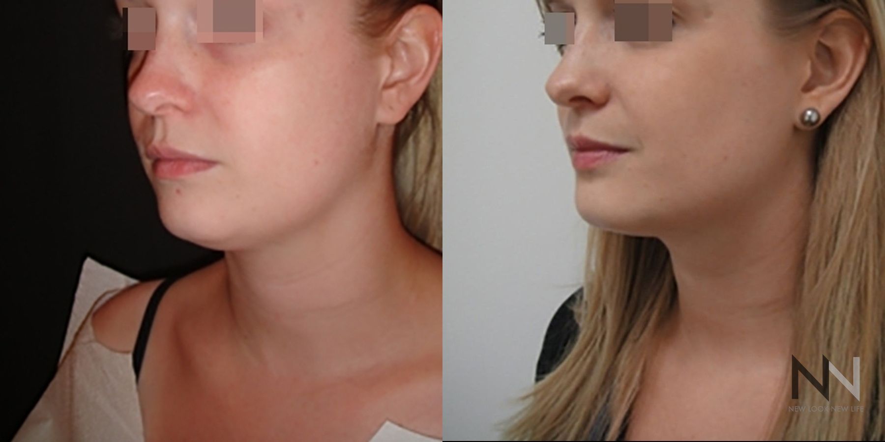 Submental liposuction showing improved jawline contour - Angle 3