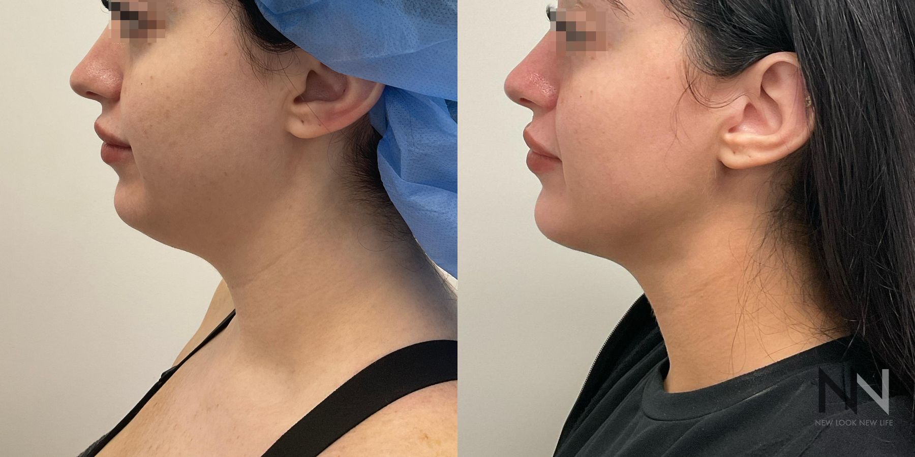 Submental liposuction showing improved jawline contour - Angle 3