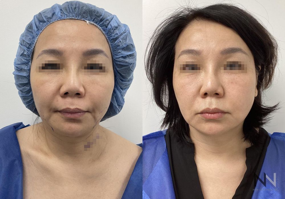 Chin Liposuction - Case 2159