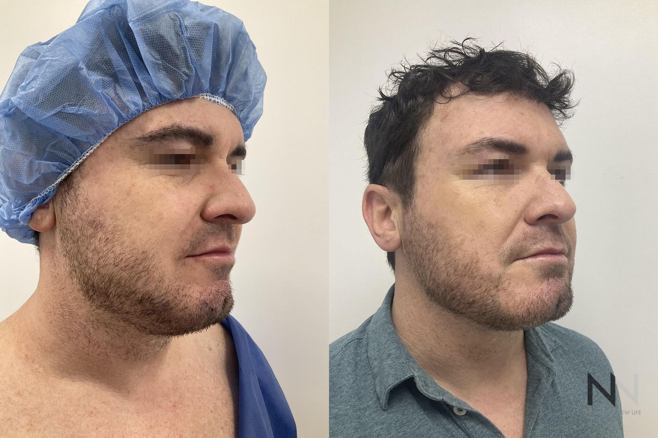 Submental liposuction showing improved jawline contour - Angle 2