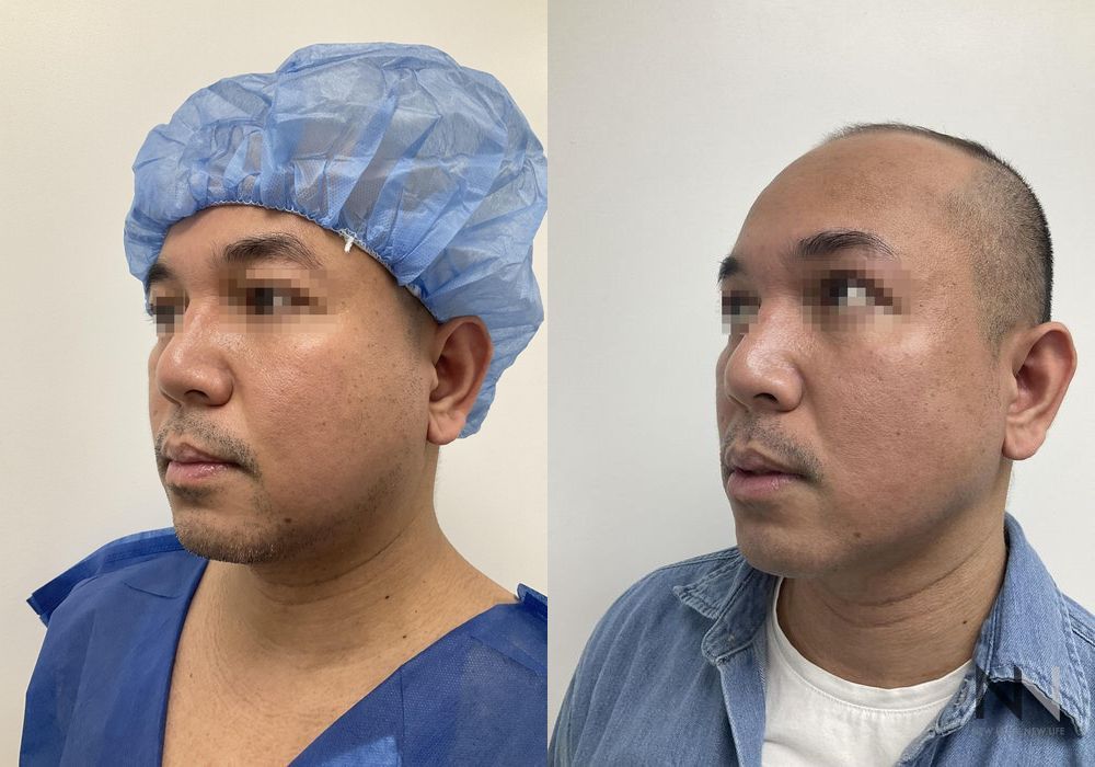 Chin Liposuction - Thumbnail 4