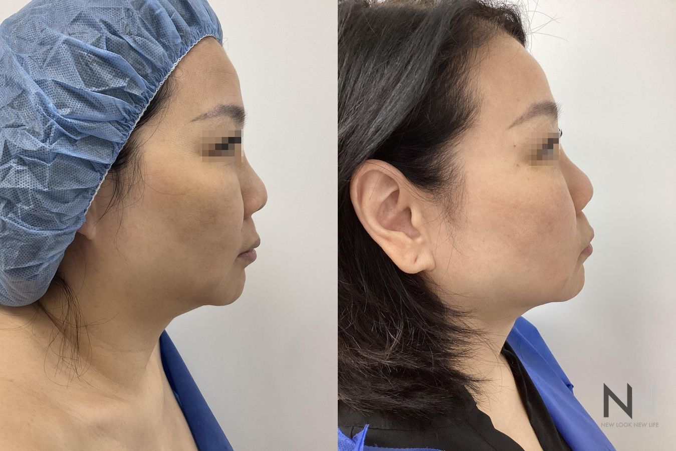 Before and after chin liposuction four months results - Angle 5