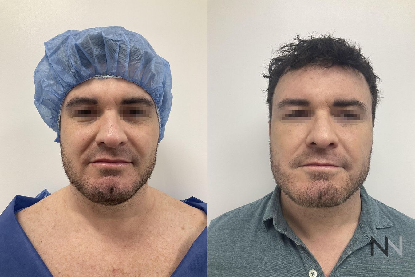 Submental liposuction showing improved jawline contour - Angle 3