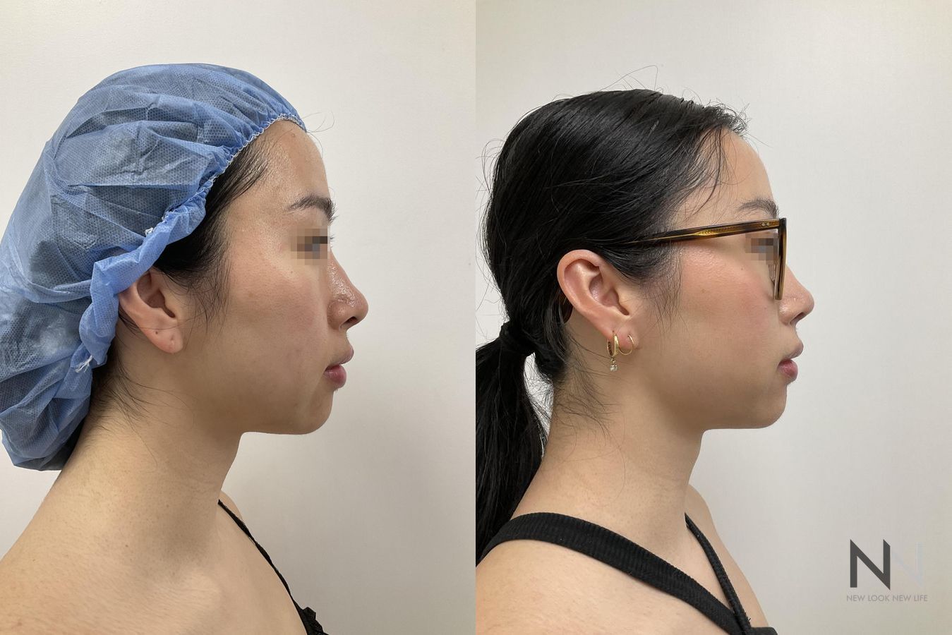 Before and after chin liposuction four months results - Angle 5