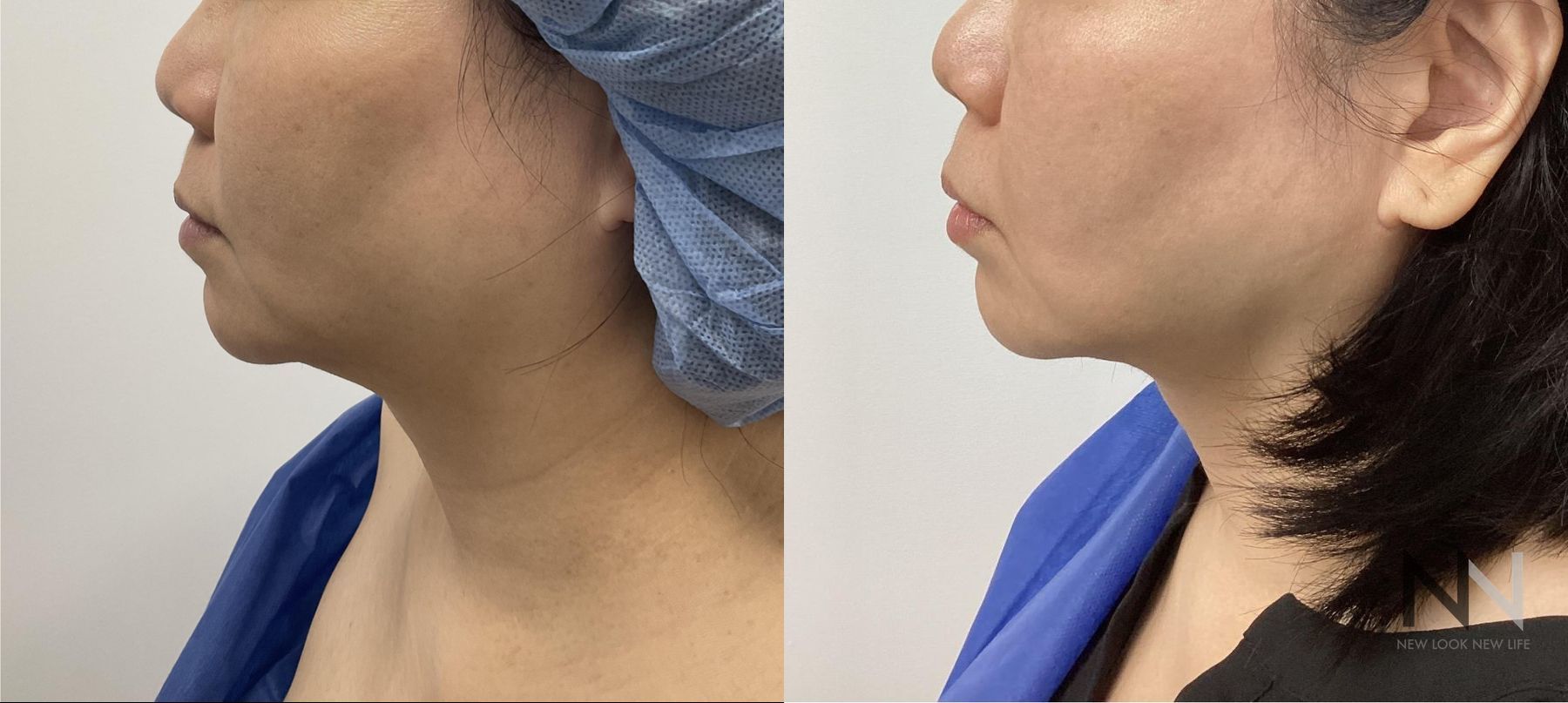 Before and after chin liposuction four months results