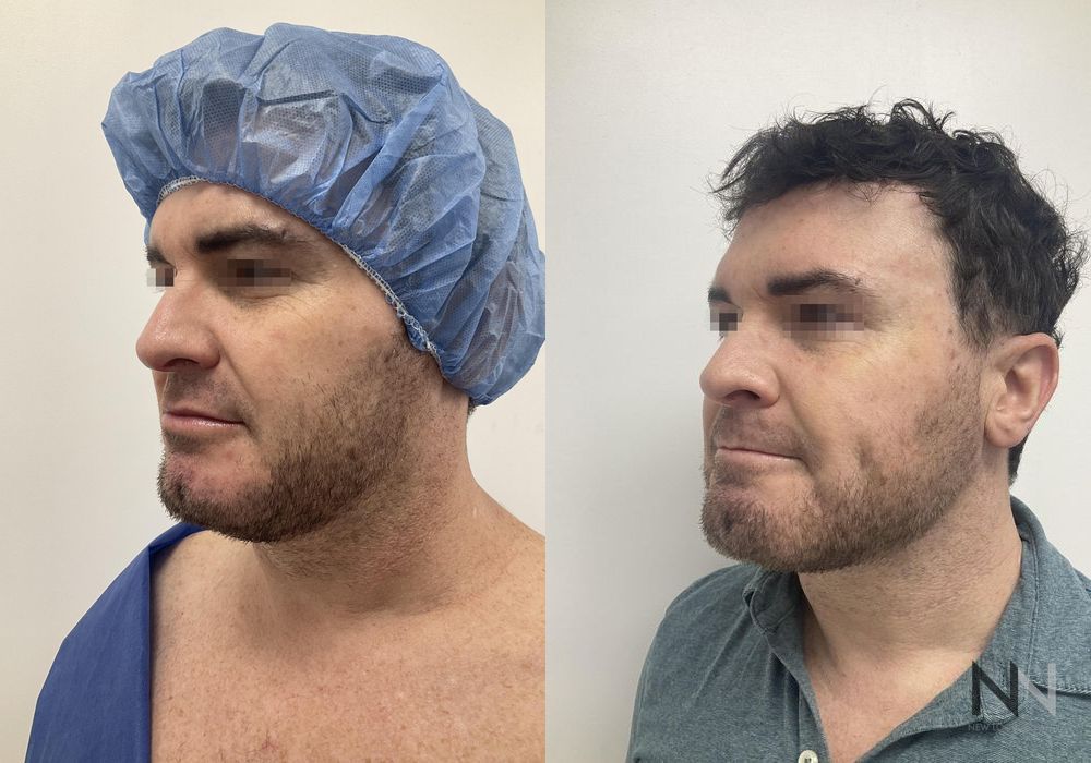 Chin Liposuction - Case 202