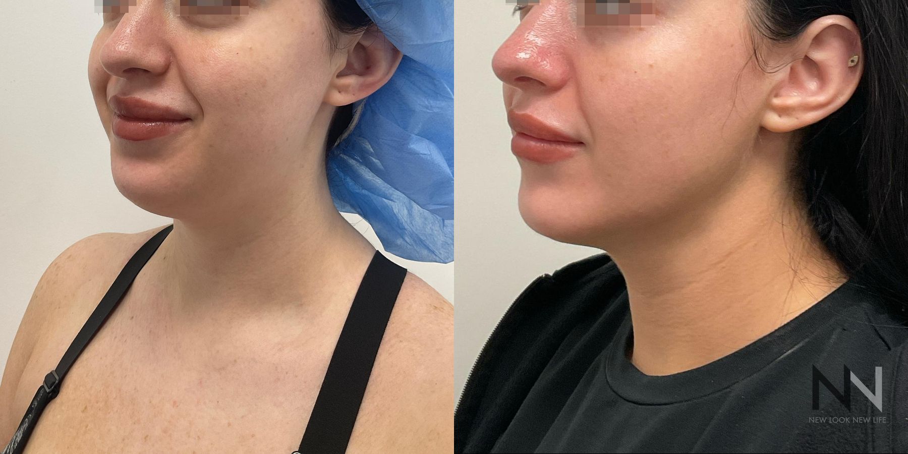 Submental liposuction showing improved jawline contour - Angle 2