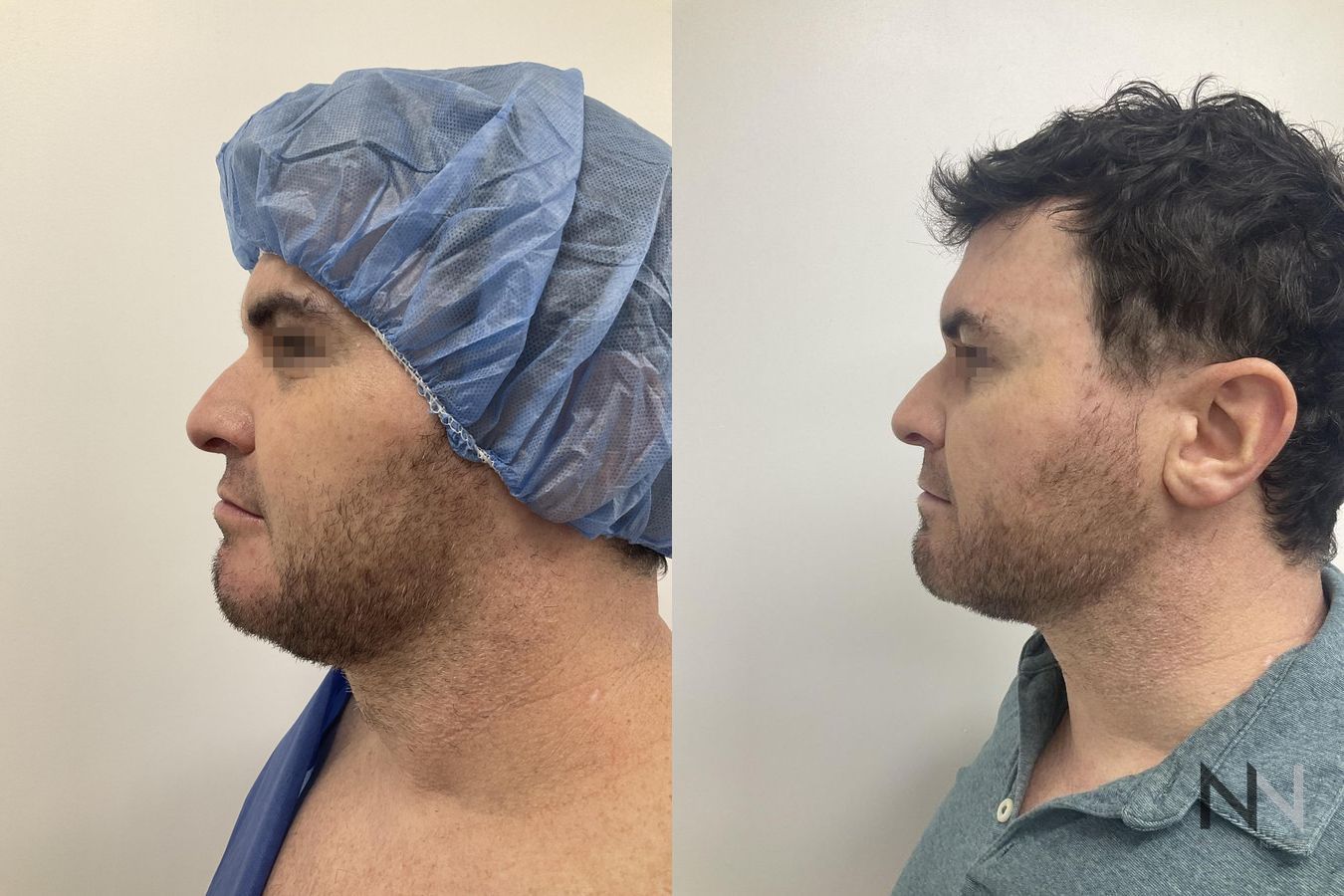 Submental liposuction showing improved jawline contour - Angle 5