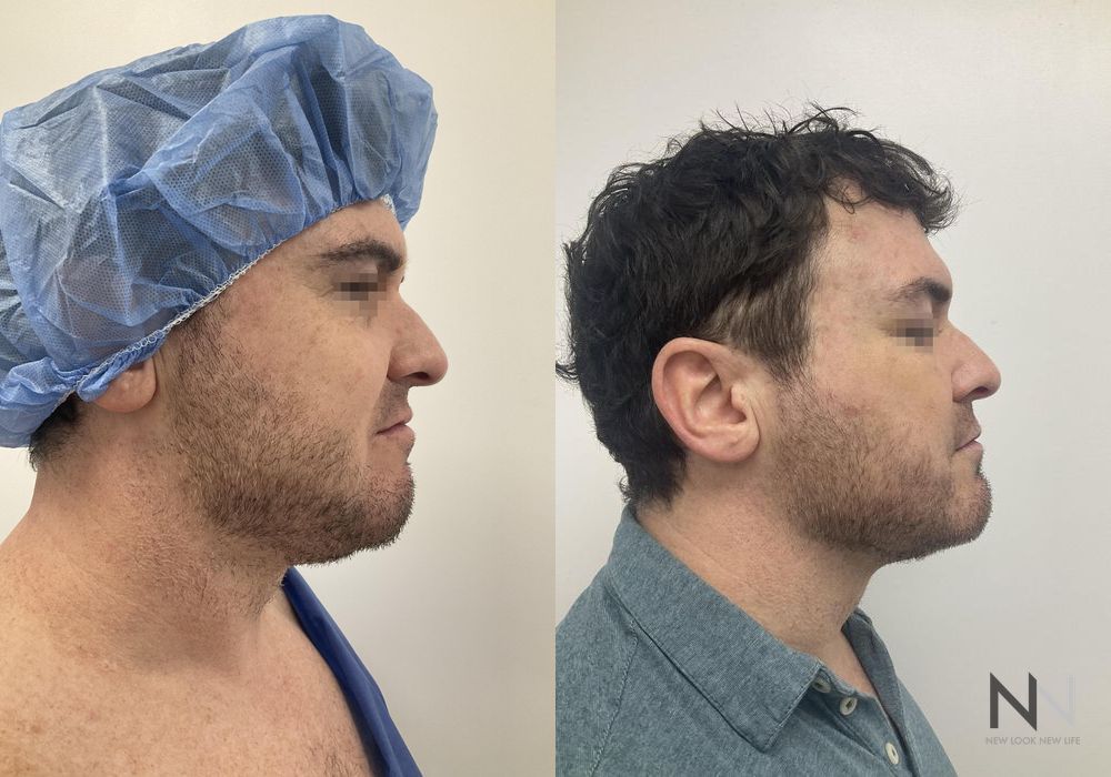 Chin Liposuction - Thumbnail 4