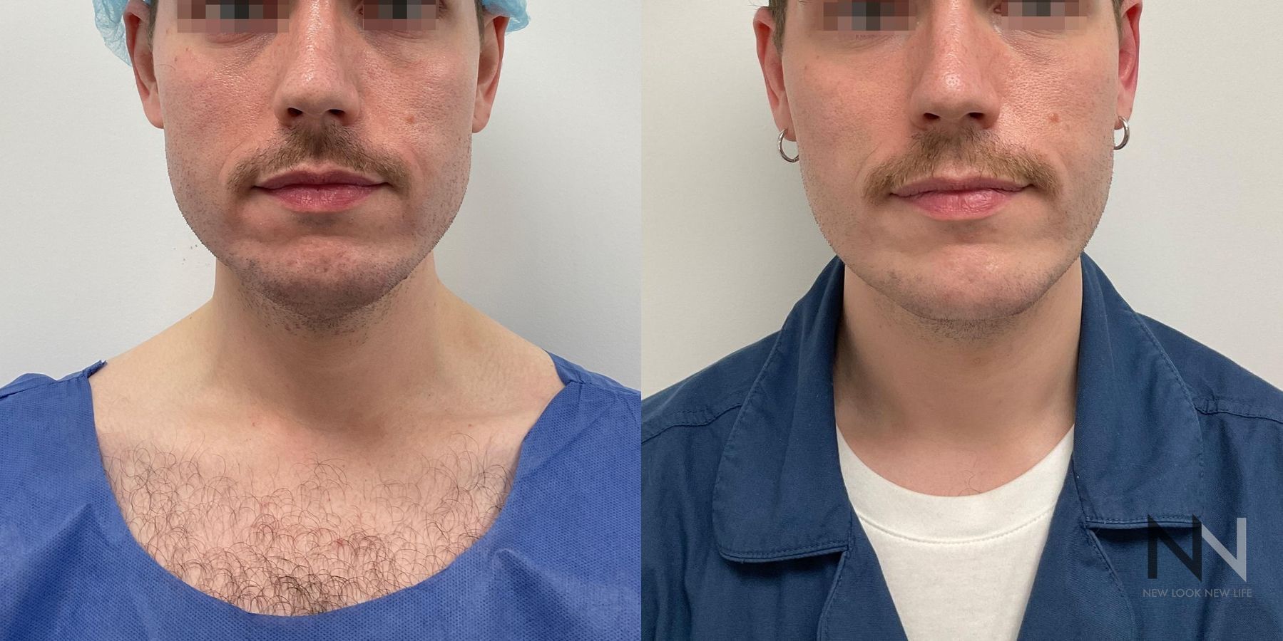 Submental liposuction showing improved jawline contour - Angle 3
