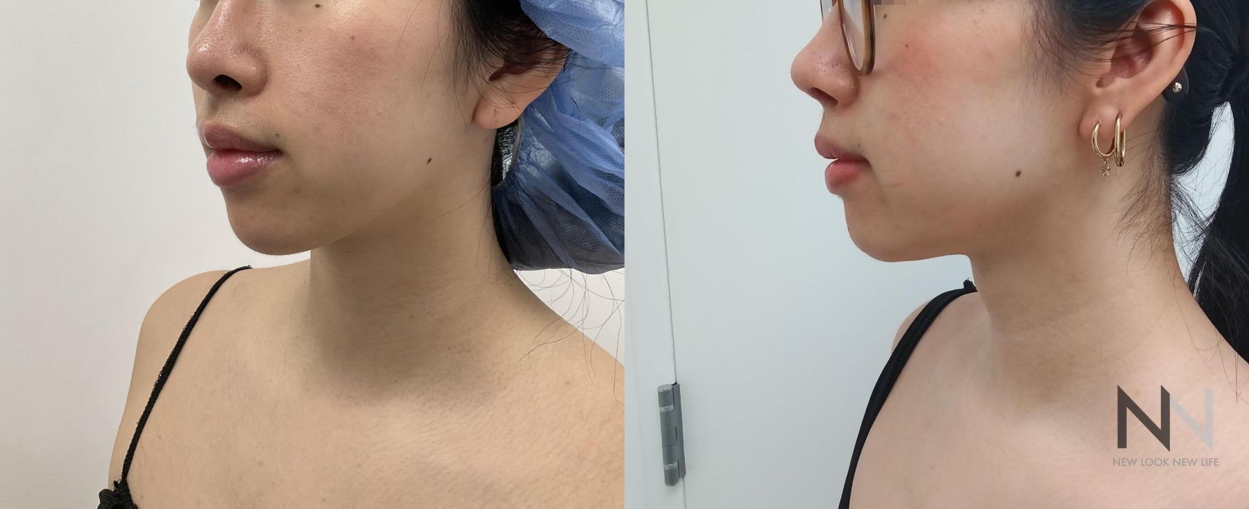 Before and after chin liposuction four months results - Angle 2