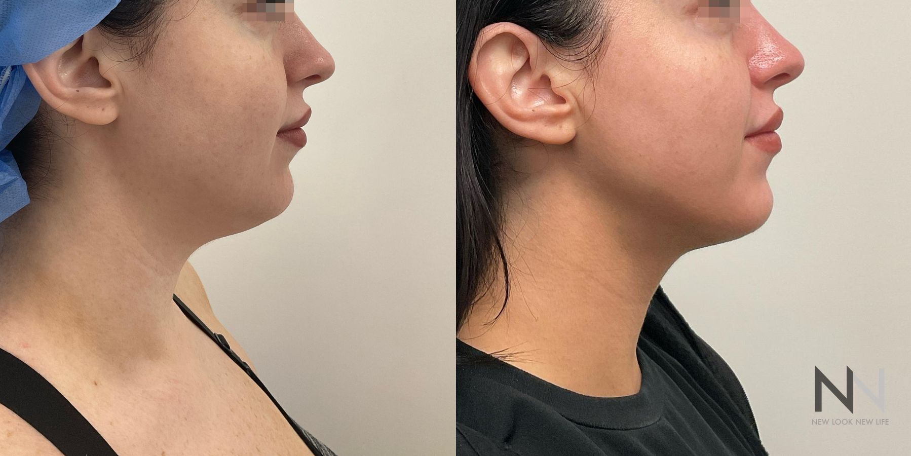 Submental liposuction showing improved jawline contour