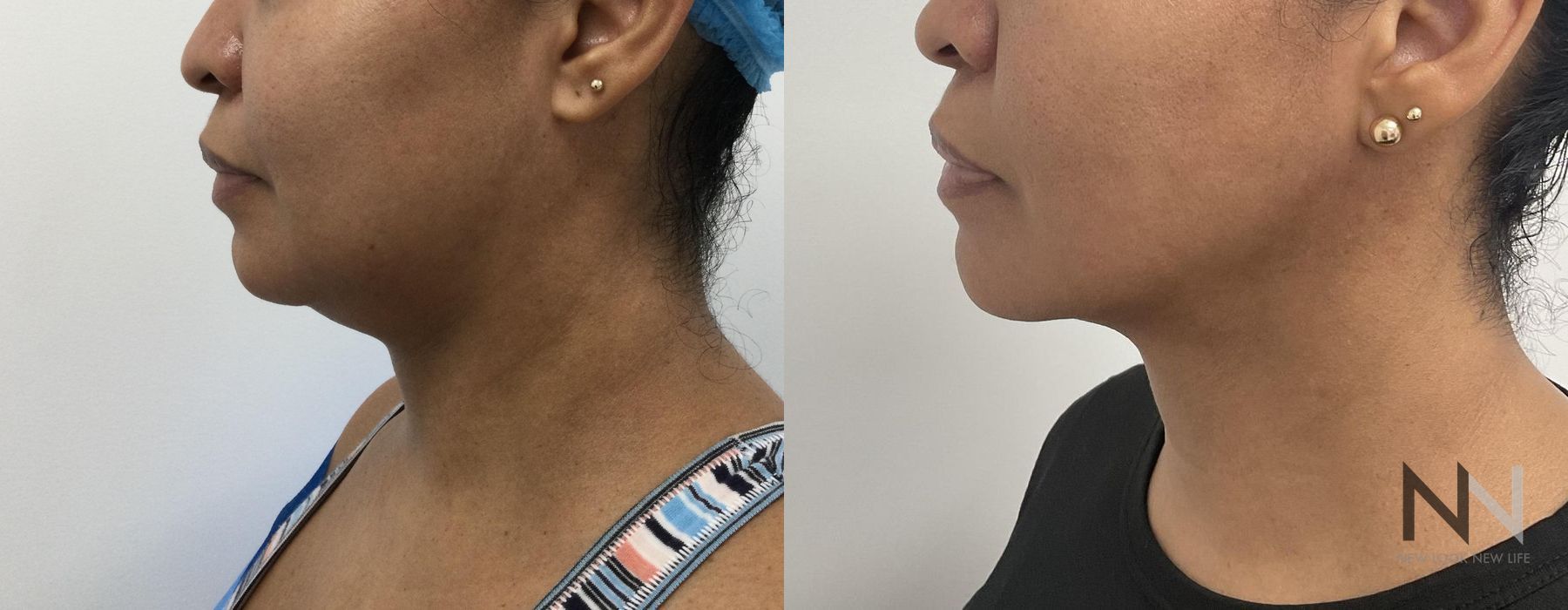 Chin Liposuction - Thumbnail 3