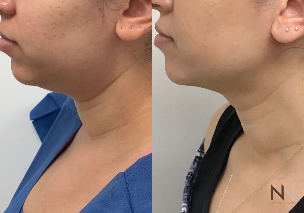 Chin Liposuction - Thumbnail 4