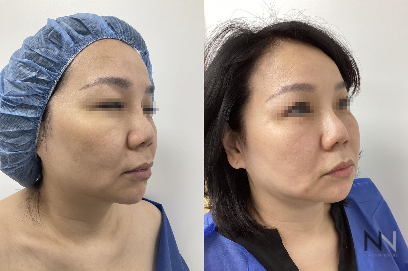 Before and after chin liposuction four months results - Angle 4