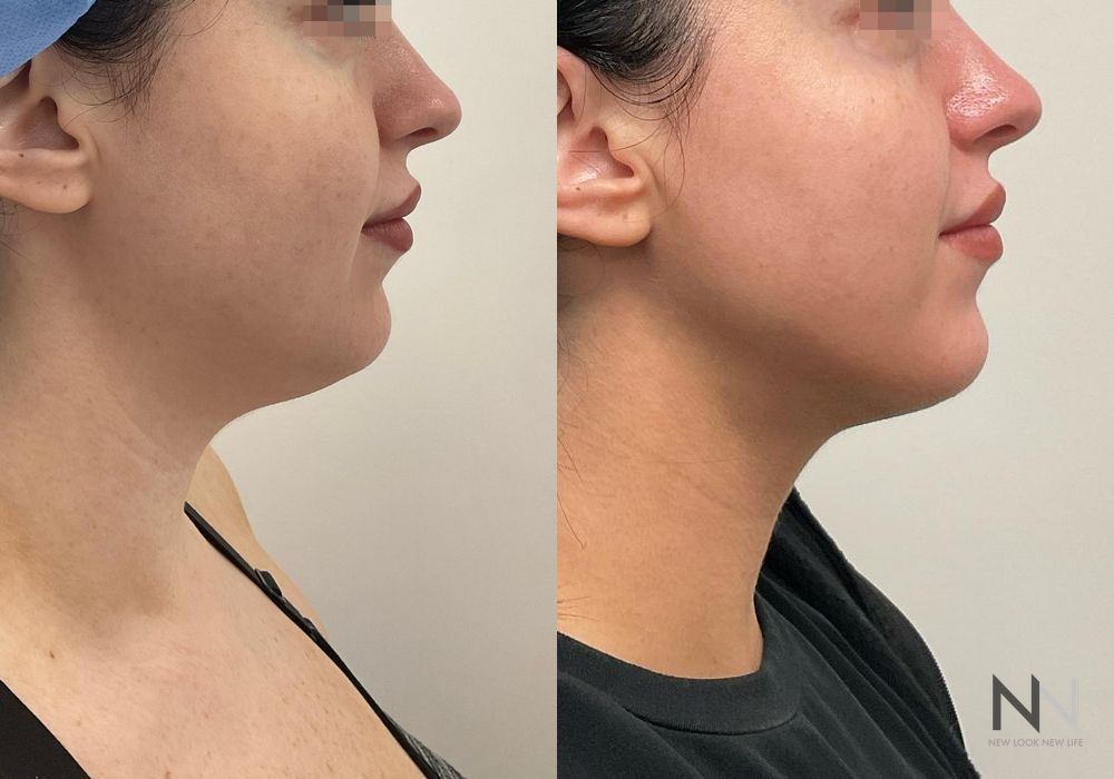 Chin Liposuction - Case 193