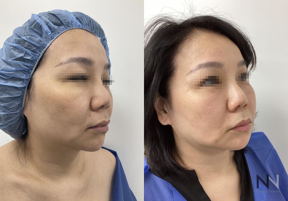 Chin Liposuction - Thumbnail 4