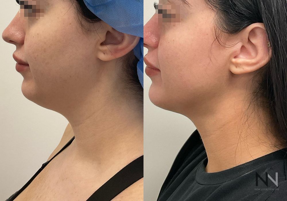 Chin Liposuction - Thumbnail 3