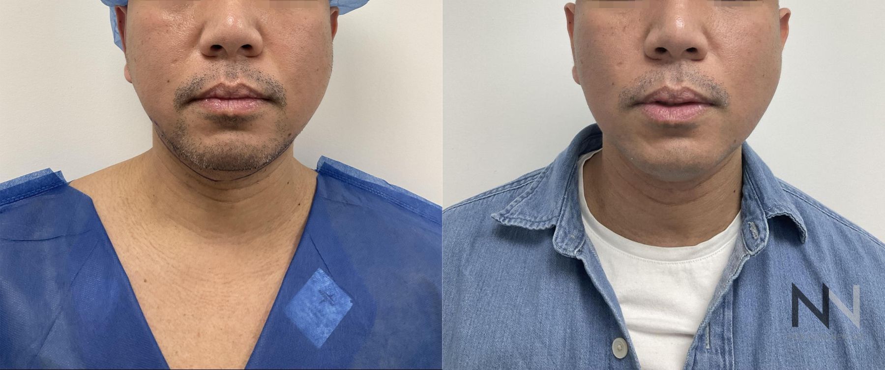 Submental liposuction showing improved jawline contour - Angle 3