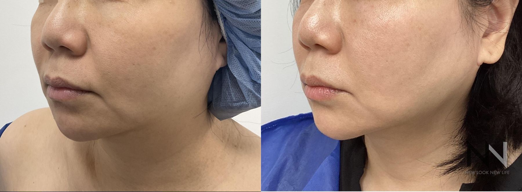 Before and after chin liposuction four months results - Angle 2