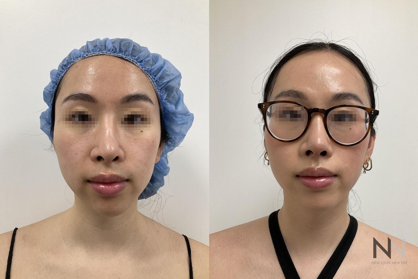 Before and after chin liposuction four months results - Angle 3