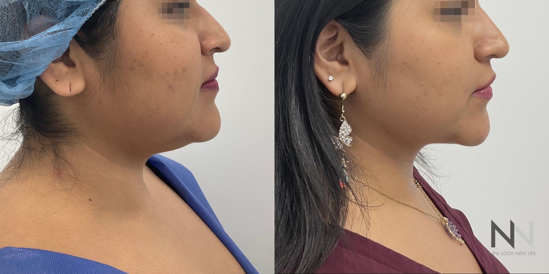 Submental liposuction showing improved jawline contour