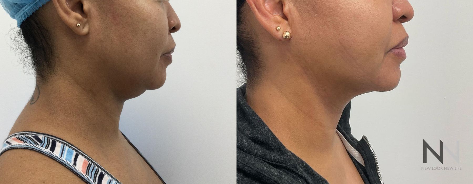 Chin Liposuction - Case 197
