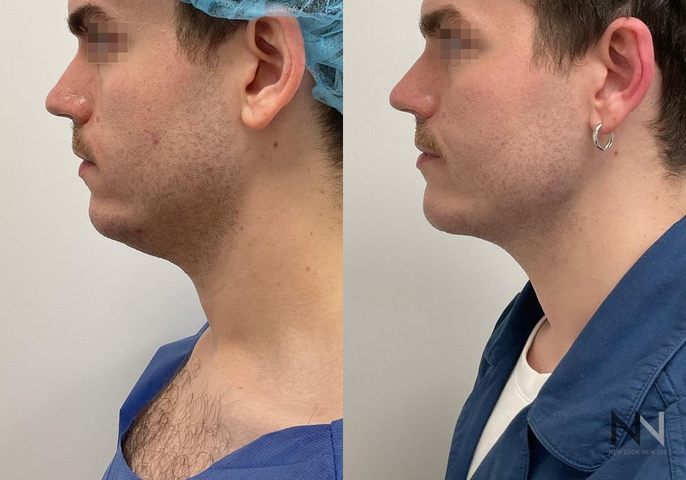 Chin Liposuction - Thumbnail 2