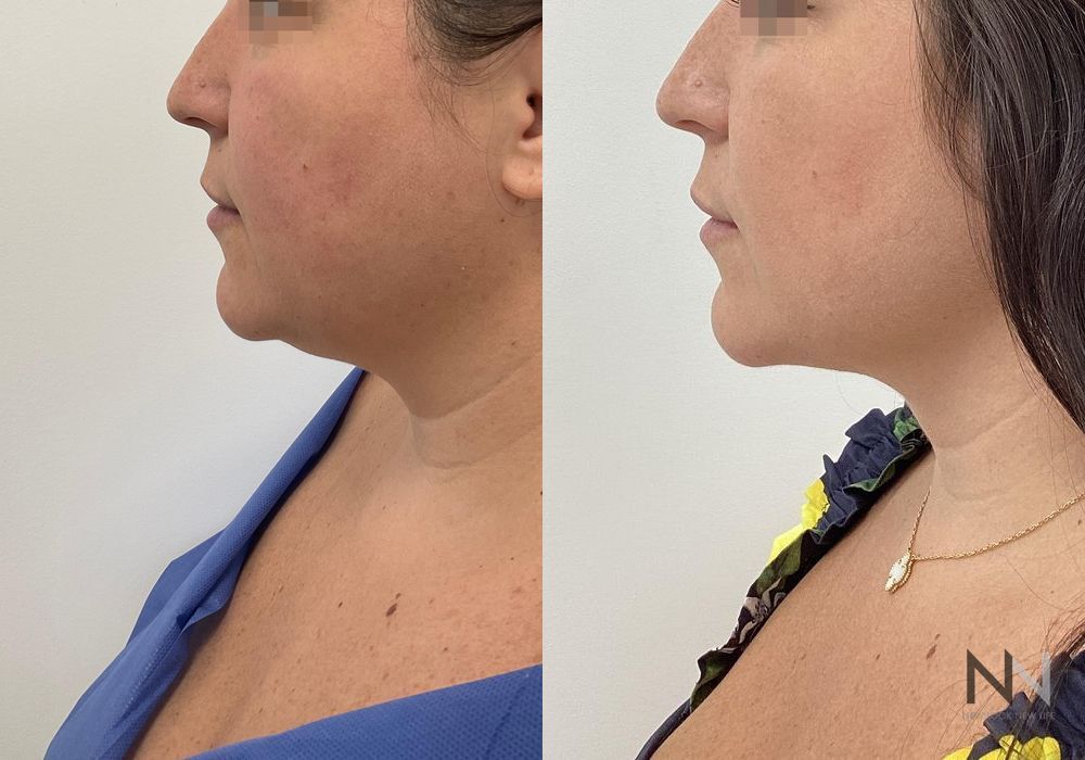Chin Liposuction - Case 2149
