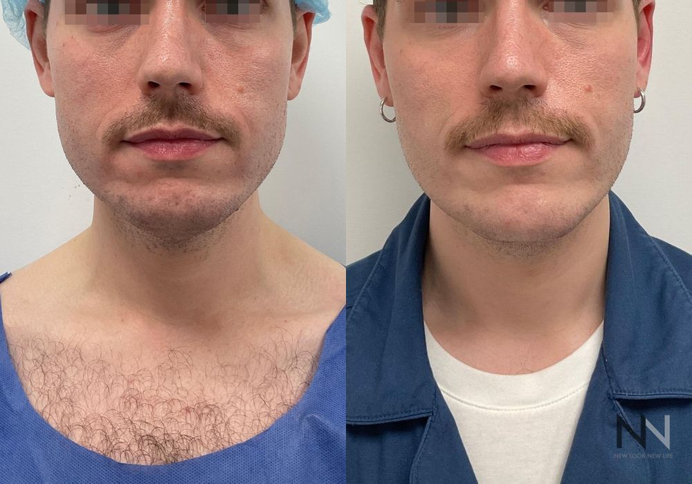 Chin Liposuction - Case 2145