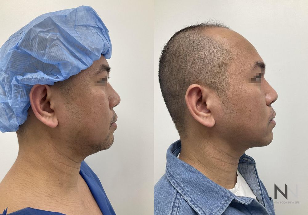 Chin Liposuction - Thumbnail 5