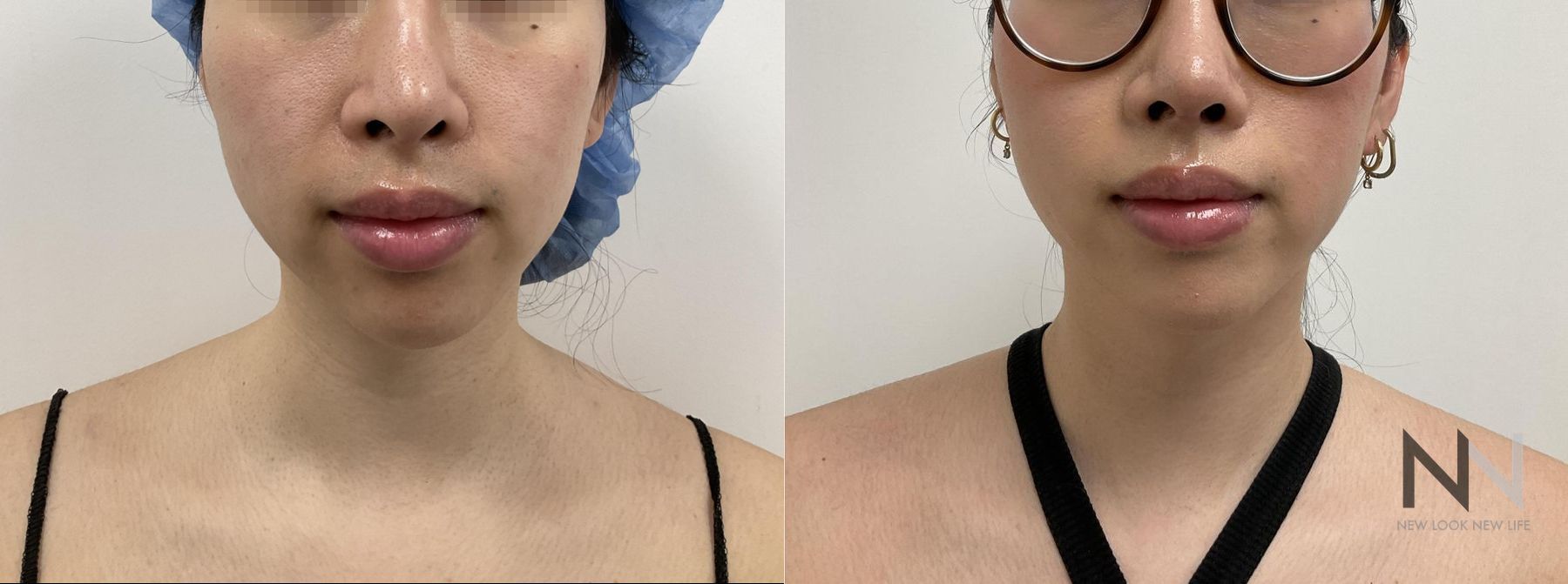 Before and after chin liposuction four months results - Angle 3