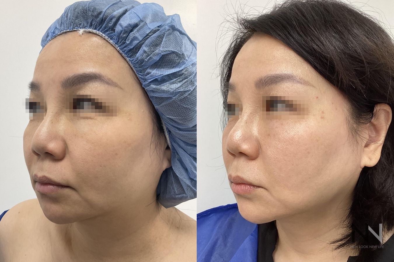 Before and after chin liposuction four months results - Angle 2